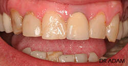 CAS DE COURONNES ANTERIEURS (TTT PARODONTAL)