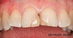 CAS DE COURONNES CERAMO CERAMIQUE ANTERIEURES