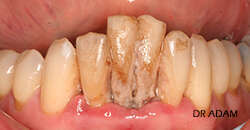 CAS D'EXTRACTION ET IMPLANTATION IMMEDIATE