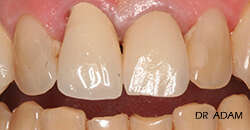 CAS D'EXTRACTION ET REMPLACEMENT PAR IMPLANT DENT ANTERIEURE