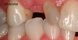 CAS D'EXTRACTION ET REMPLACEMENT PAR IMPLANT