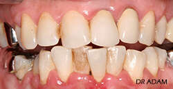 CAS DE TRAITEMENT PARODONTAL 2