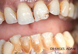 CAS DE TRAITEMENT PARODONTAL 3