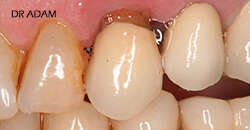 CAS D'EXTRACTION ET REMPLACEMENT