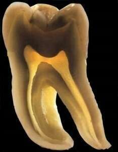 Cas clinique : Traitements endodontiques
