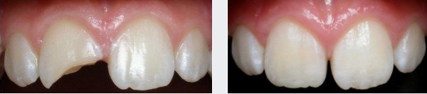 Cas clinique : Dentisterie Adhésive / Dentisterie Esthétique