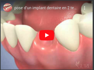 pose d'un implant dentaire en 2 temps avec un pilier titane