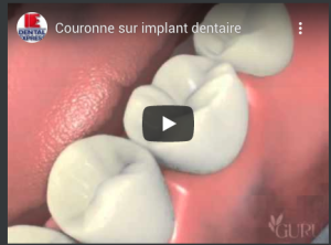 Couronne sur implant dentaire