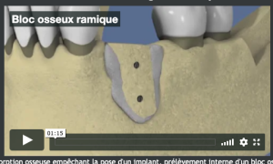 Bloc osseux d'origine ramique