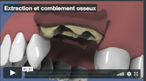 Extraction et comblement osseux