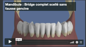 Mandibule : Bridge complet scellé sans fausse gencive