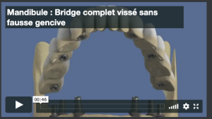 Mandibule : Bridge complet vissé sans fausse gencive