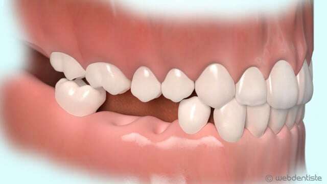 Conséquence de la perte des dents postérieures