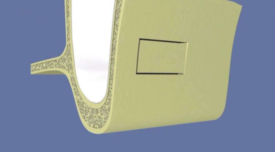 Comblement de sinus par abord latéral sans pose d’implant