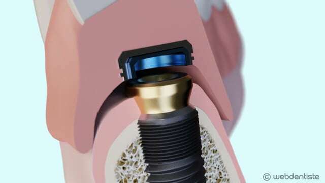 Stabilisation d'une prothèse par 2 boutons pressions
