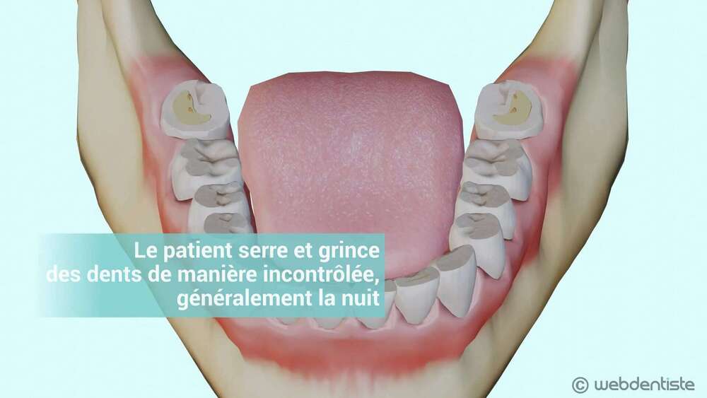 Bruxisme et usure dentaire