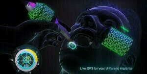 X Guide animation de Nobel Biocare