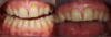 Greffe de gencive suite à une demande esthétique pour des déchaussements multiples avant et après