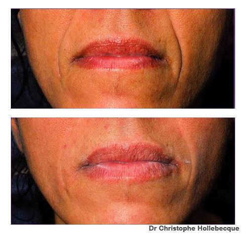 LES INJECTIONS THERAPEUTIQUES D'ACIDE HYALURONIQUE