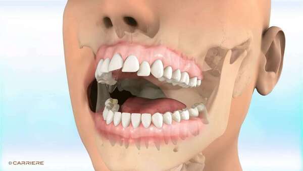 Carriere motion classe ii