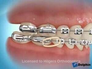 Correction avec élastique classe 2