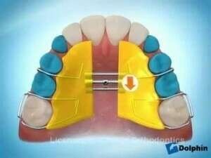 Tour de clé pour la plaque palatine