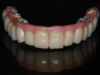 Bridge complet sur implant (bridge)