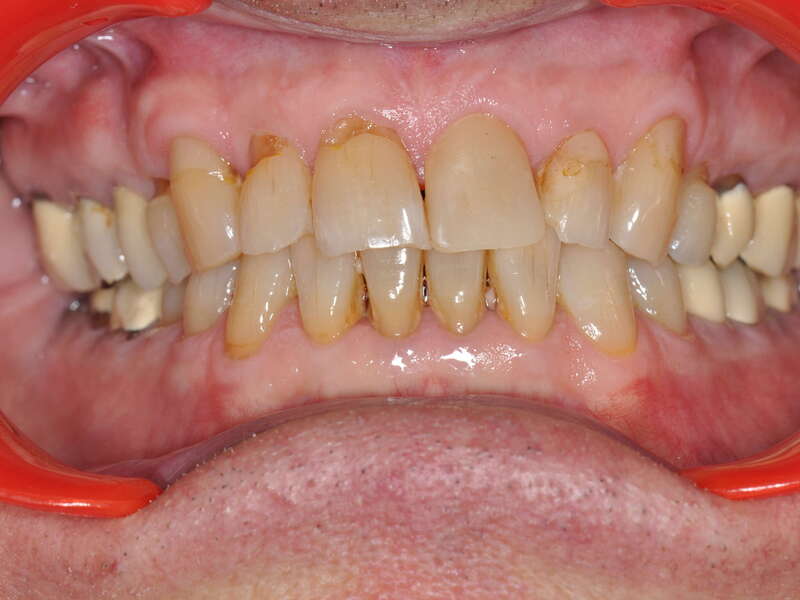 fracture_suite_usure__3_