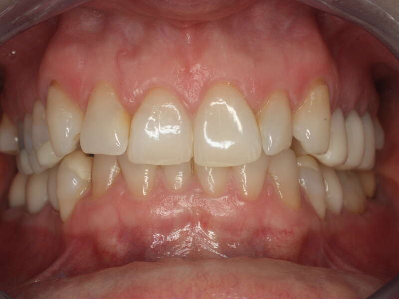 traitement_occlusal_2