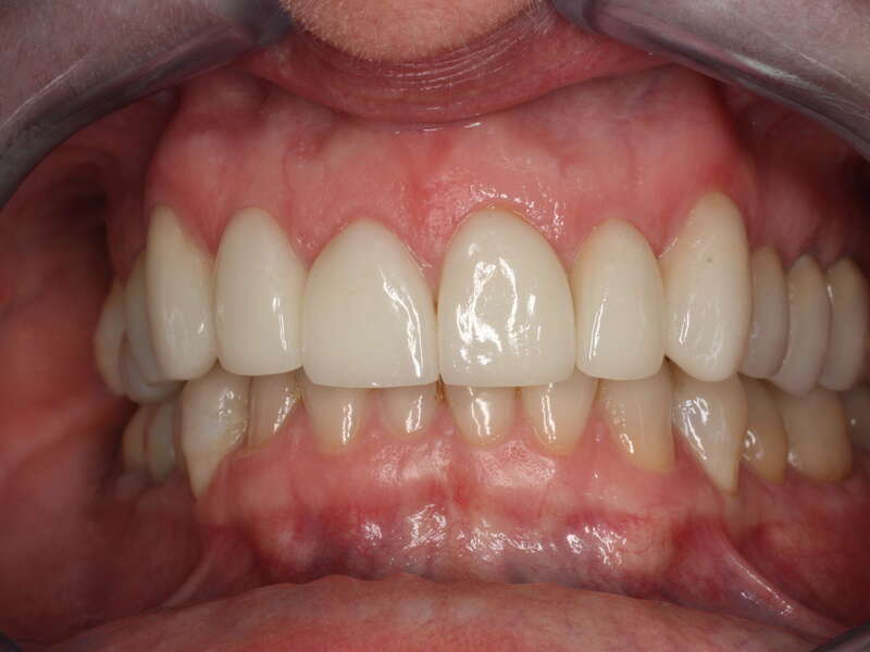 traitement_occlusal_3