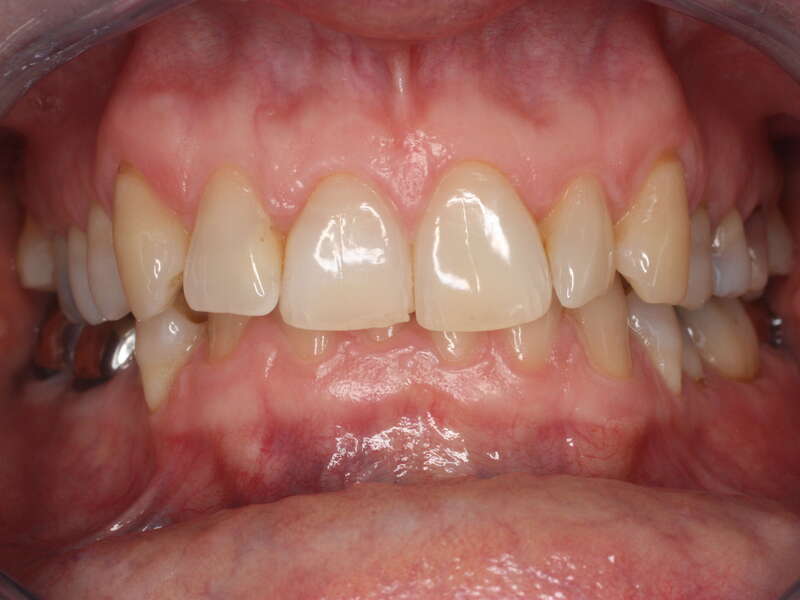 traitement_occlusal_1