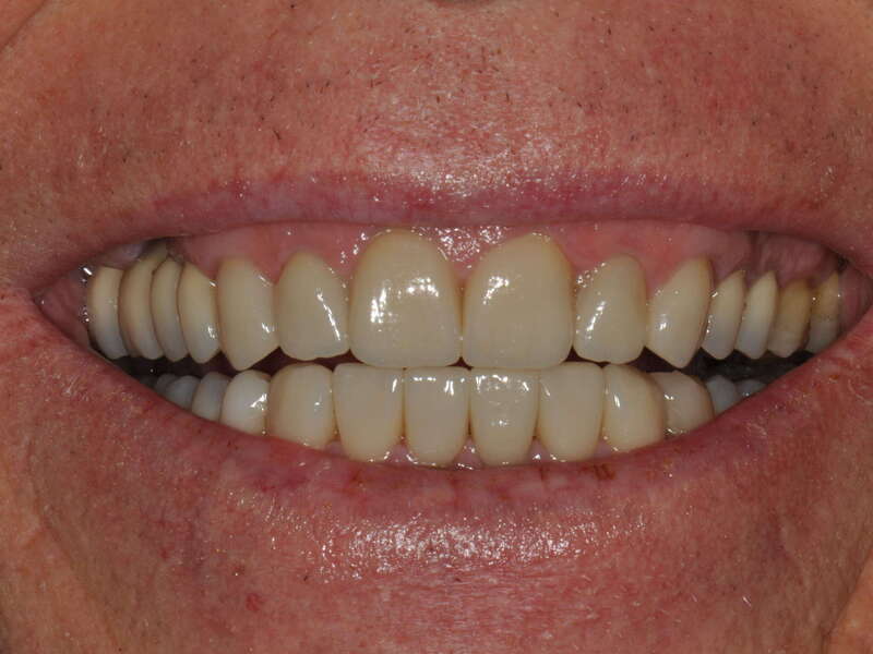 rehabilitation_globale_usure_bruxisme_facettes_implants___4_