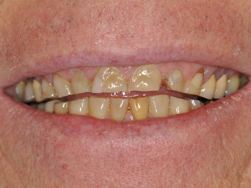 rehabilitation_globale_usure_bruxisme_facettes_implants___2_