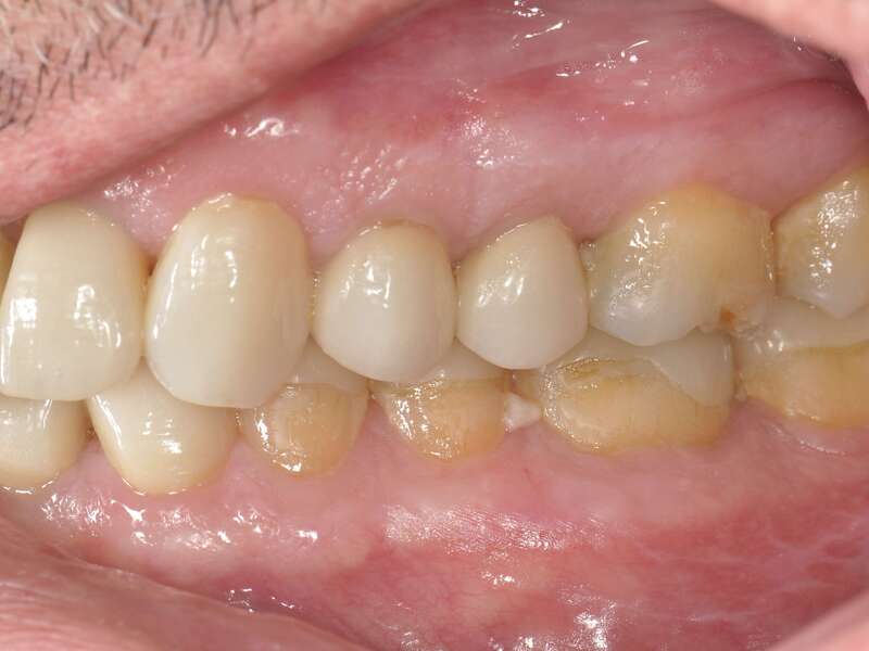 rehabilitation_globale_usure_acide_couleur_dvo__8_