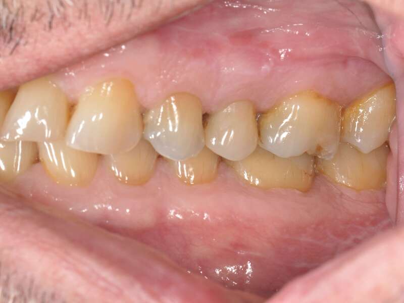 rehabilitation_globale_usure_acide_couleur_dvo__7_