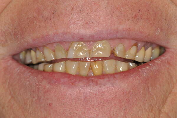 Usure dentaire : quand faut-il traiter, et quand peut-on surveiller ?