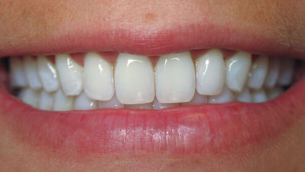 blanchiment dentaire Genève, blanchiment des dents, dentiste Genève Champel, éclaircissement dentaire, prix blanchiment Genève