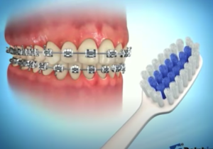 Brossage des dents avec des brackets