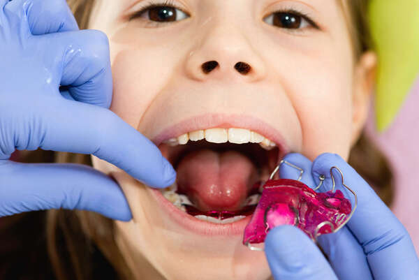 Orthodontie : Traitement précoce ou Orthodontie Fonctionnelle