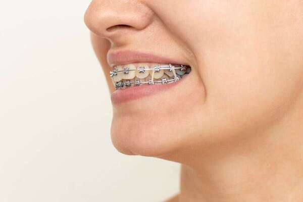 Les élastiques en orthodontie