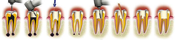 Endodontie Casablanca - Dr Nawal LARAICHI CHRAIBI