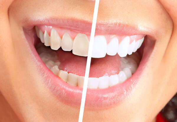Eclaircissement ambulatoire