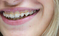 L'ORTHODONTIE