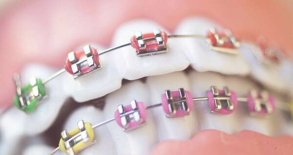 LES ÉLASTIQUES EN ORTHODONTIE