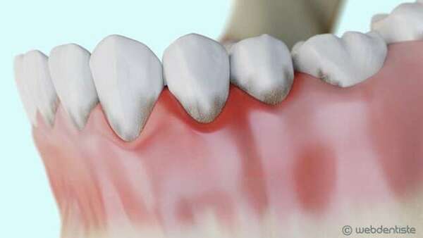 Parodontite et formation de la poche parodontale