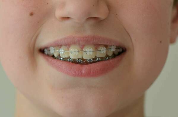 LES PREMIERS JOURS AVEC UN APPAREIL MULTI-ATTACHES