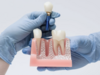 Pose d'implant - Dr ZEITOUN et MARTINEZ à Toulouse