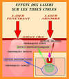 effets des lasers sur les tissus cibles