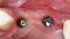 Implant sur deux dents avant