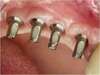 Remplacement de plusieurs dents par plusieurs implants - pose